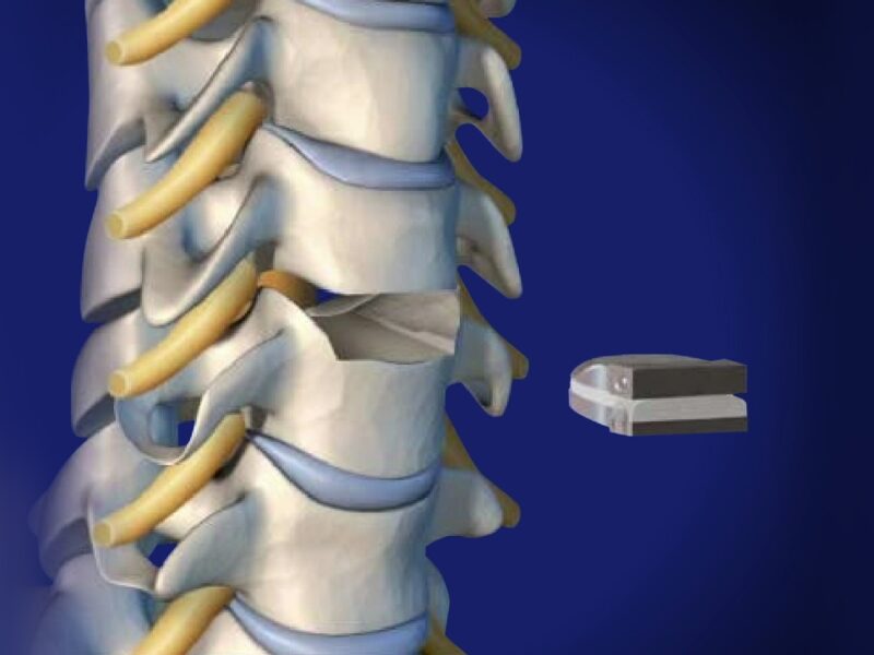 Spinal Disc Replacement